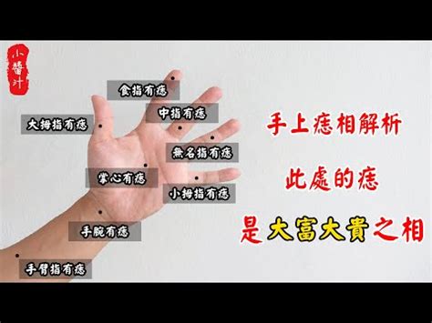 手指有痣代表什麼|手背有痣財運佳！手指、手掌心有痣代表甚麼？從手痣。